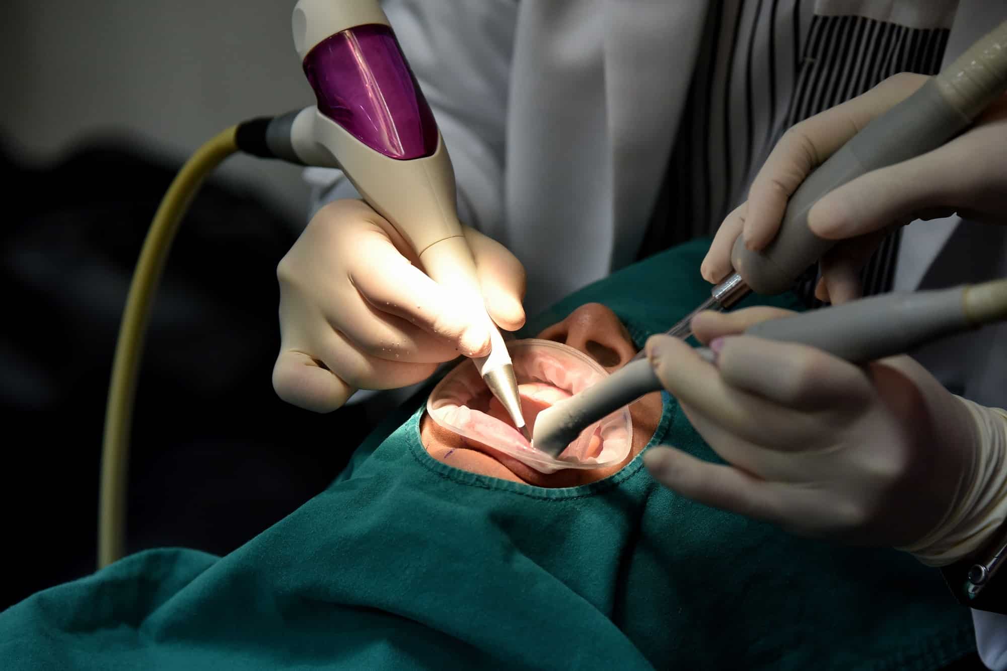 Quels sont les différents types de détartreurs dentaires ?