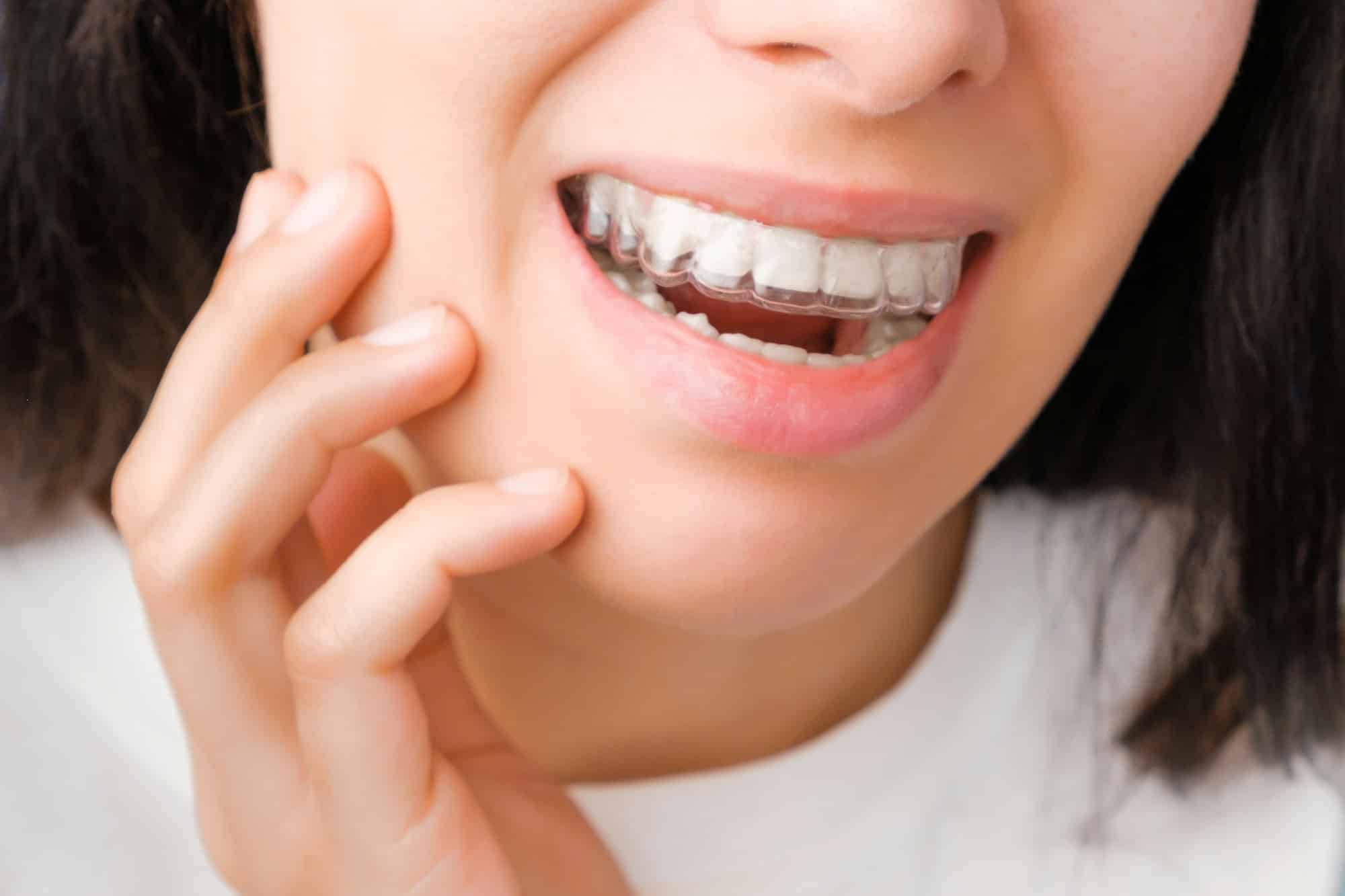 Urgence dentiste : quand utiliser des gouttières dentaires ?